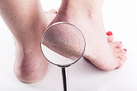 Medical Conditions May Cause Cracked Heels