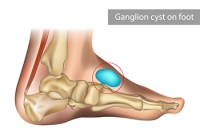 Causes and Treatment of Ganglion Cysts