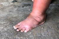 Causes and Symptoms of Swollen Feet
